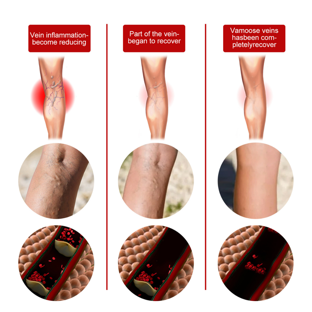 Leg Comfort Herbal Patches – Daily Support | Vital Woman