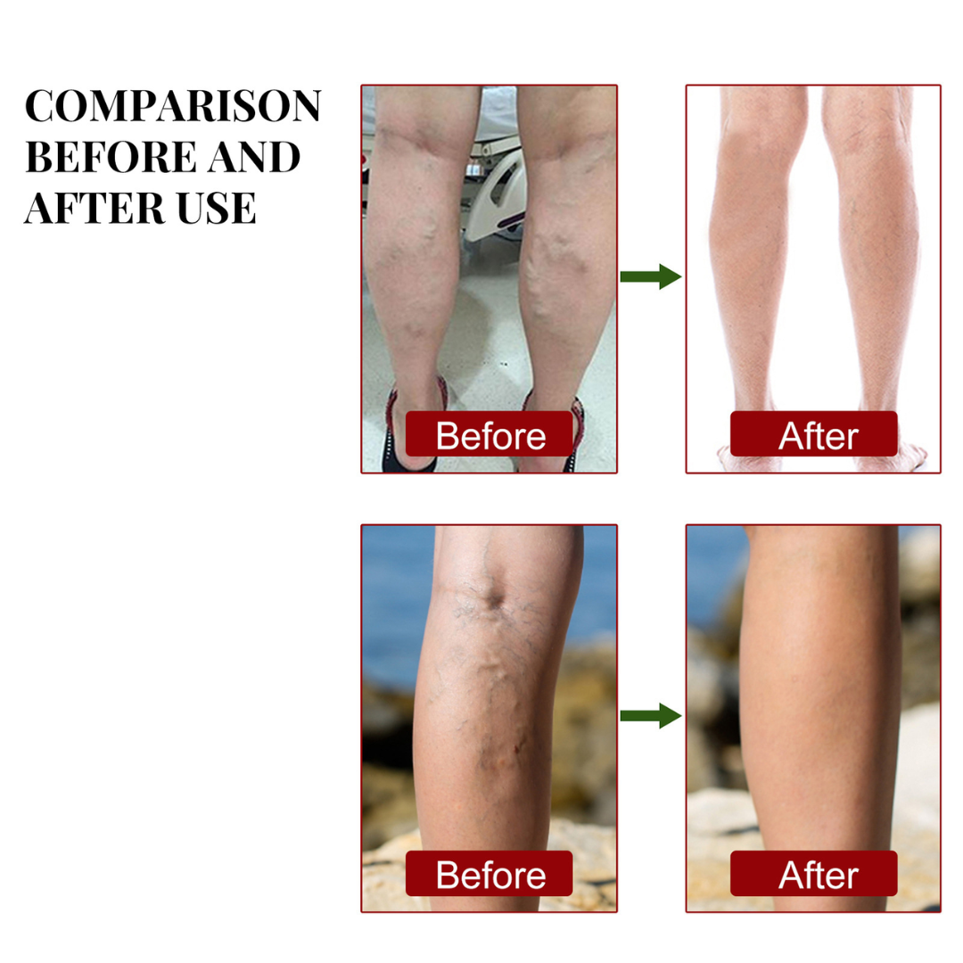 Leg Comfort Herbal Patches – Daily Support | Vital Woman