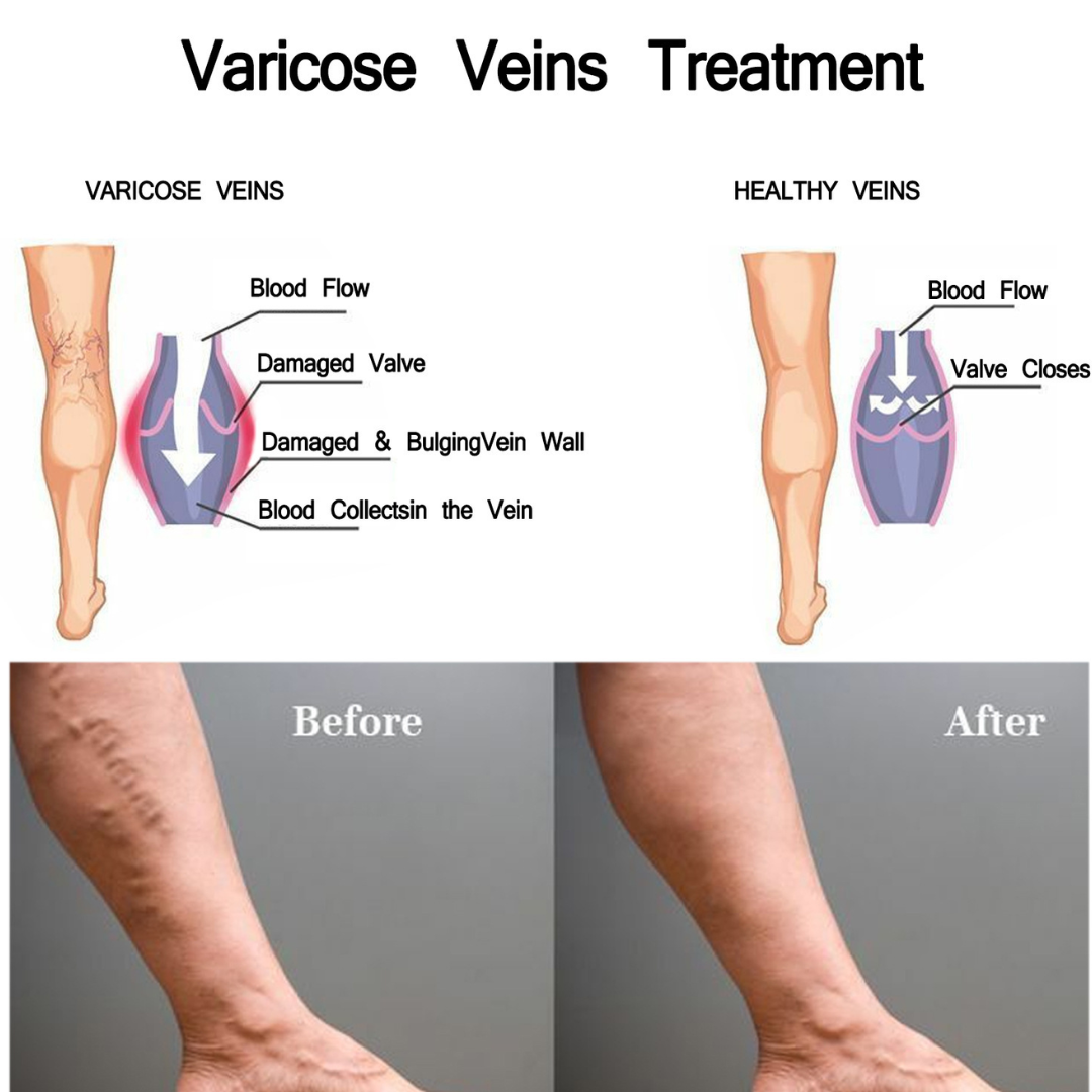 Leg Comfort Herbal Patches – Daily Support | Vital Woman